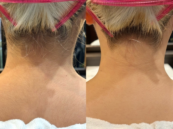 成人式前のうなじシェービング！人気です🪒