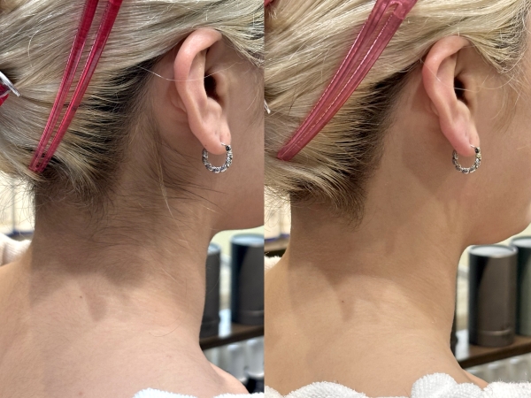 うなじのビフォーアフター紹介！シェービング/成人式