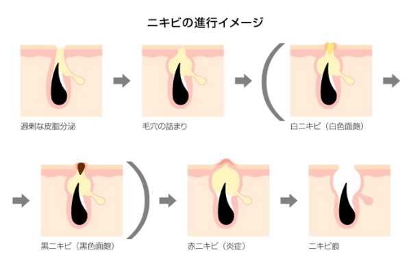 肌荒れの原因...